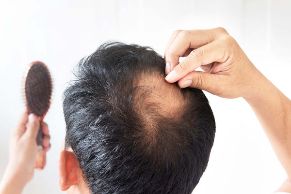 Hair loss near your hair parting, crown or temples?
