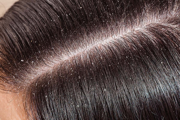 How do I know if I have dandruff?