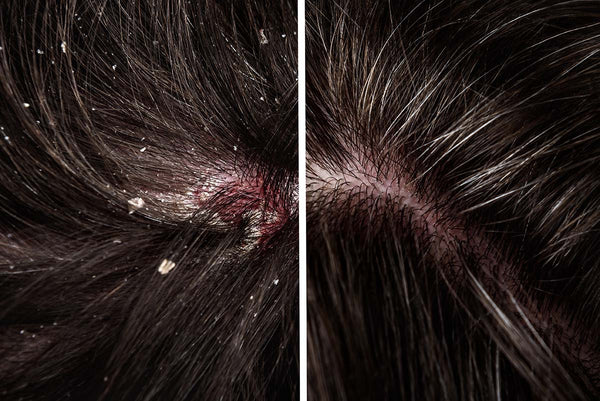 Are Scalp Ringworms Real?