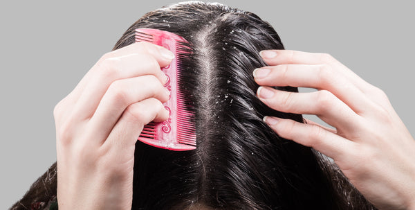 Dandruff can be easily mistaken for dry scalp